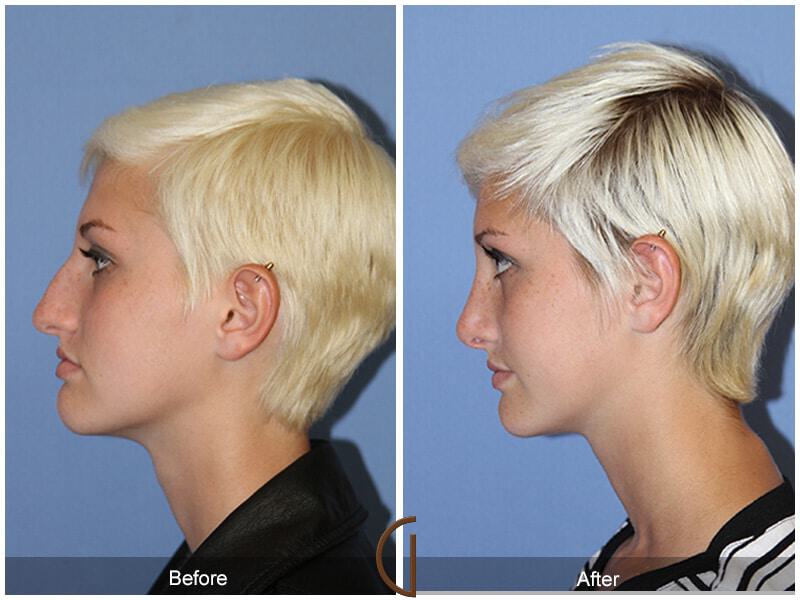 Female Rhinoplasty Before & After Photo