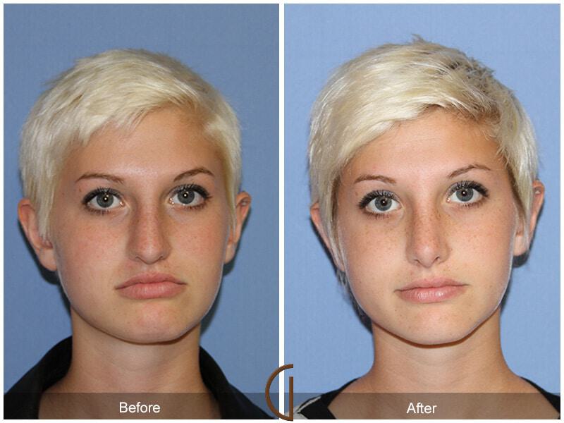 Female Rhinoplasty Before & After Photo