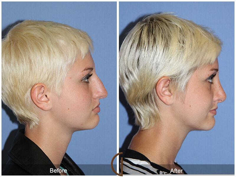 Female Rhinoplasty Before & After Photo