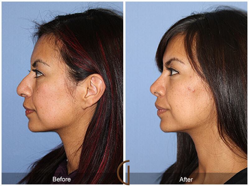 Female Rhinoplasty Before & After Photo