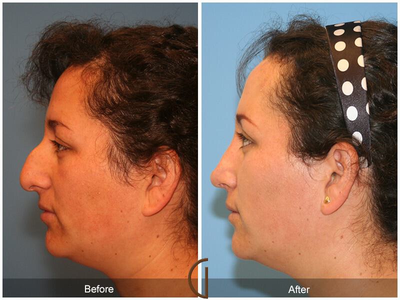 Female Rhinoplasty Before & After Photo