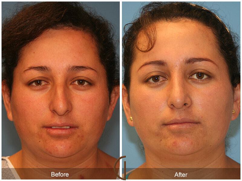 Female Rhinoplasty Before & After Photo