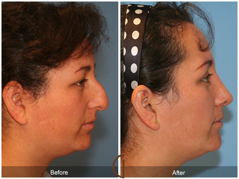 Female Rhinoplasty Before & After Photo