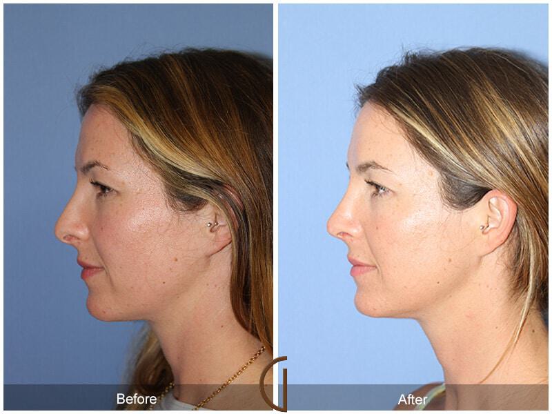 Female Rhinoplasty Before & After Photo