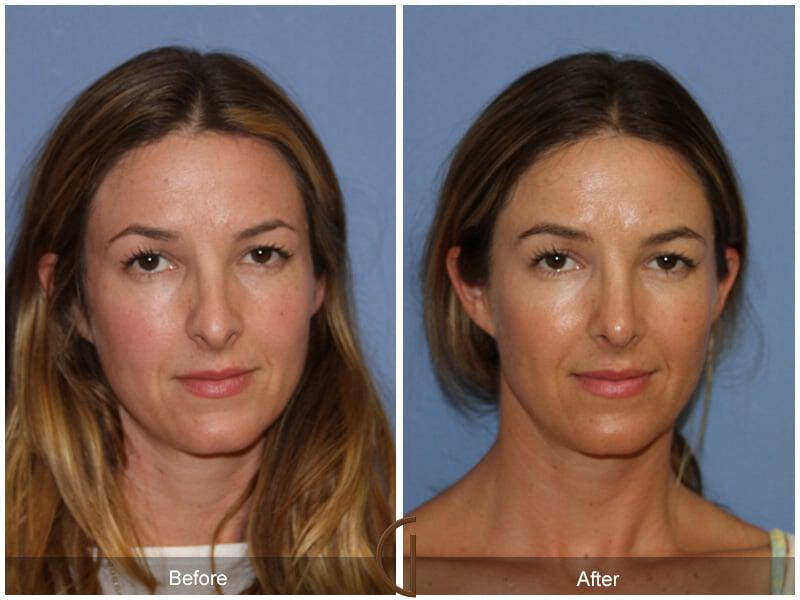 Female Rhinoplasty Before & After Photo