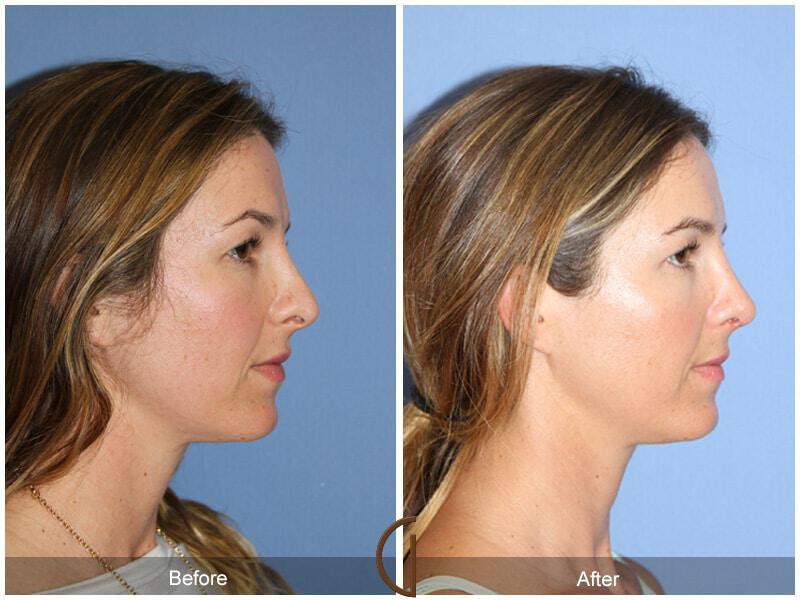 Female Rhinoplasty Before & After Photo