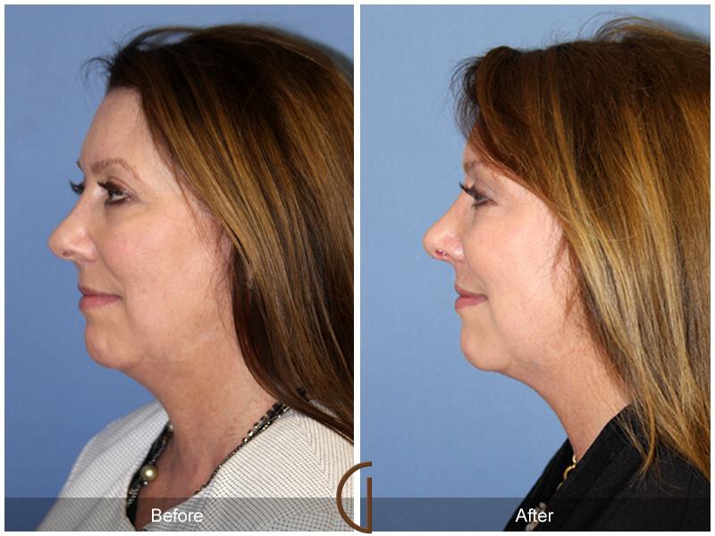 Female Rhinoplasty Before & After Photo