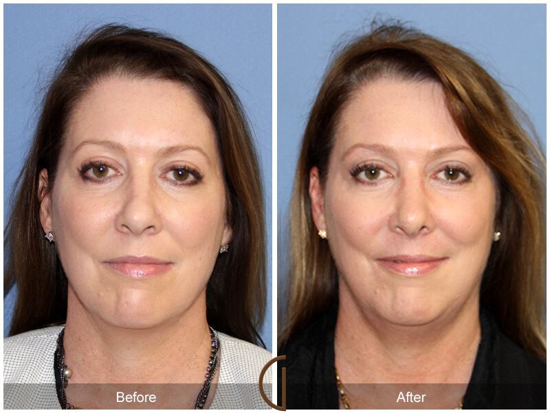 Female Rhinoplasty Before & After Photo