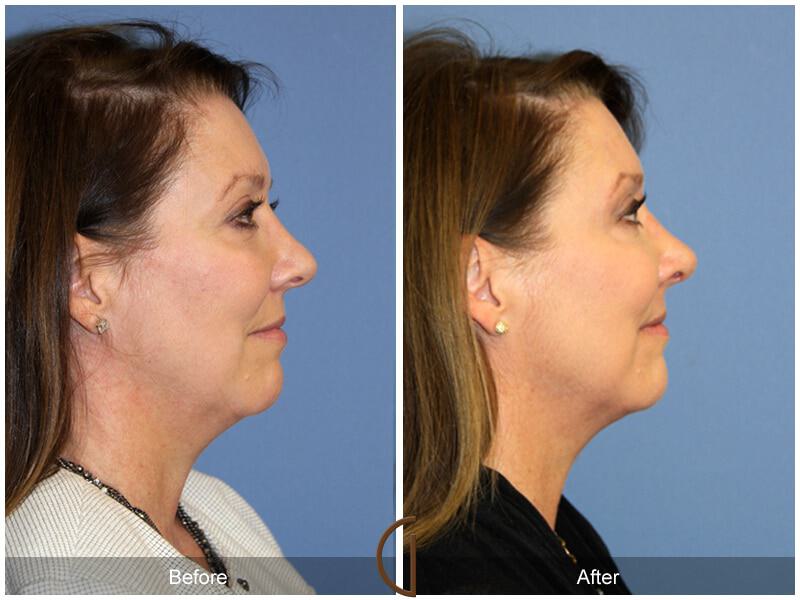 Female Rhinoplasty Before & After Photo