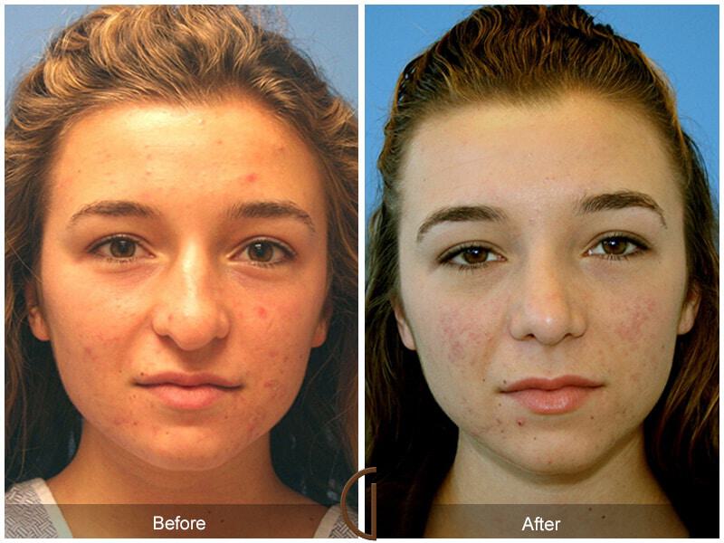 Female Rhinoplasty Before & After Photo