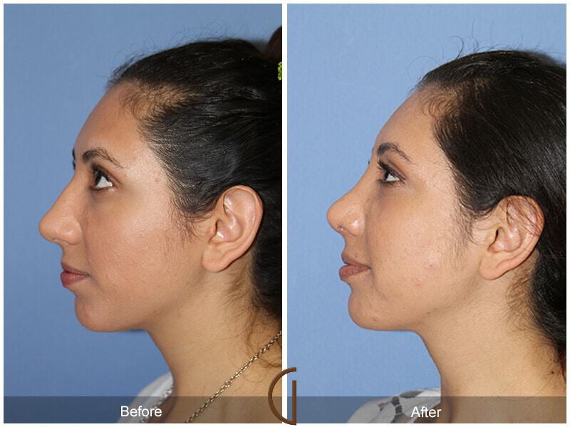 Female Rhinoplasty Before & After Photo