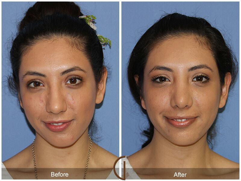 Female Rhinoplasty Before & After Photo