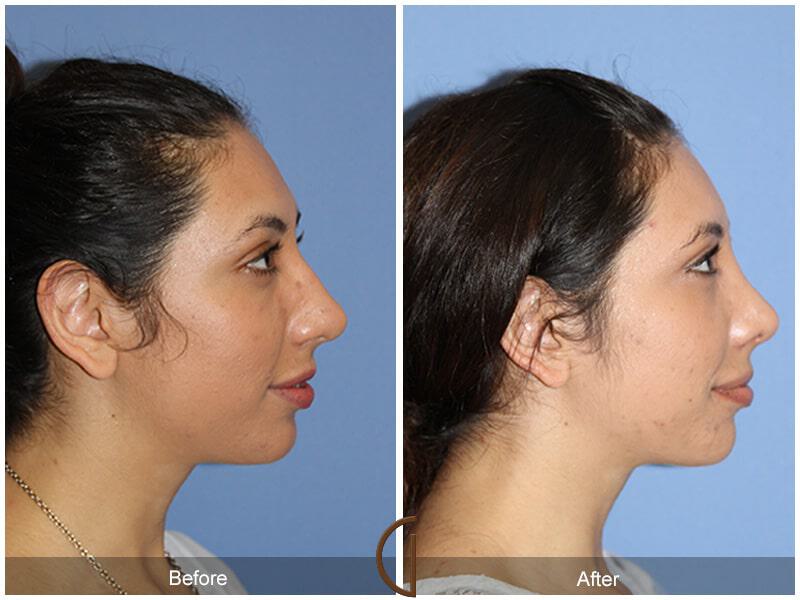 Female Rhinoplasty Before & After Photo