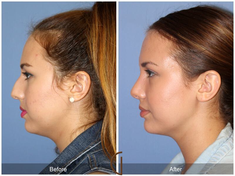 Female Rhinoplasty Before & After Photo