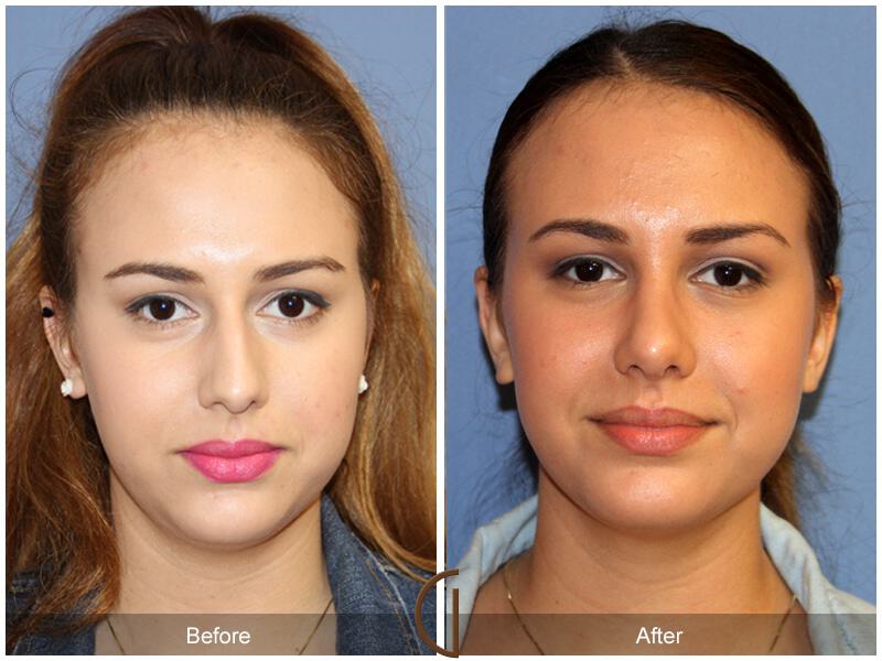 Female Rhinoplasty Before & After Photo