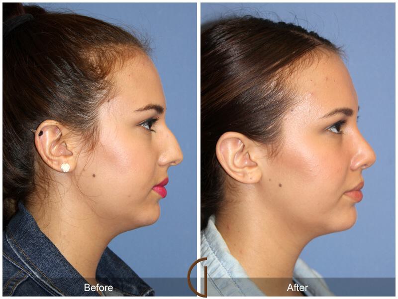 Female Rhinoplasty Before & After Photo