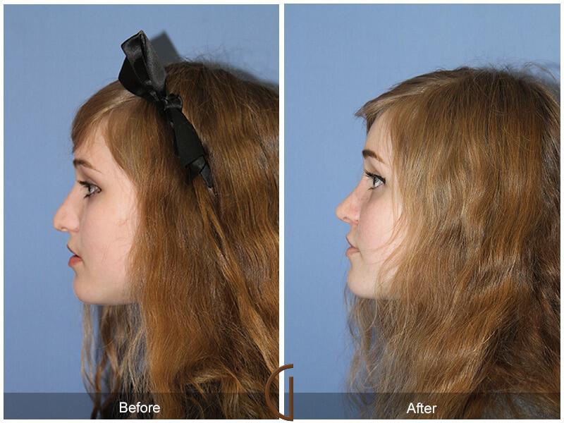 Female Rhinoplasty Before & After Photo