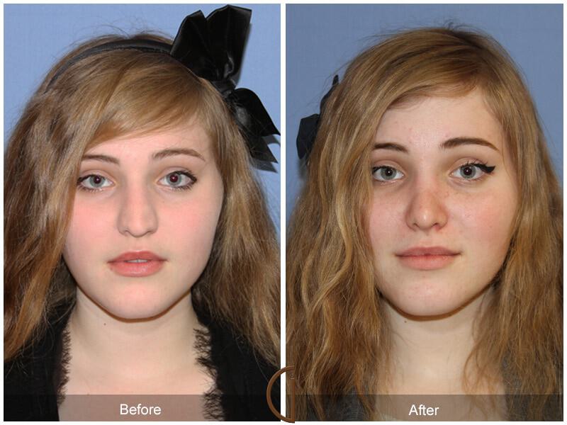 Female Rhinoplasty Before & After Photo