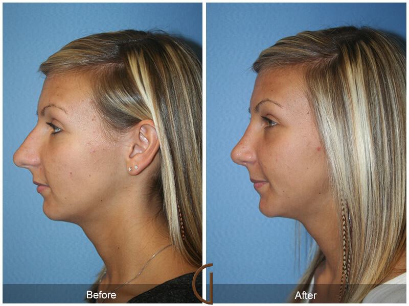 Female Rhinoplasty Before & After Photo