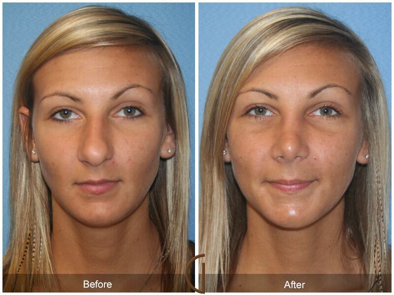 Female Rhinoplasty Before & After Photo