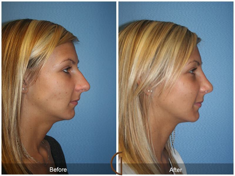 Female Rhinoplasty Before & After Photo