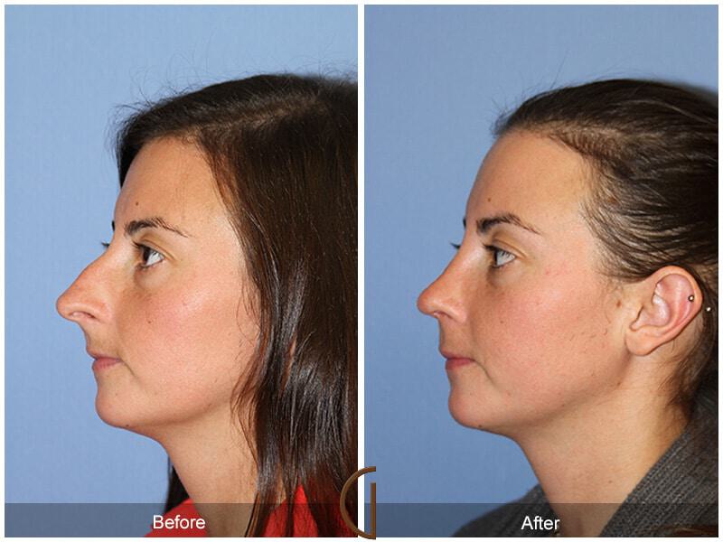 Female Rhinoplasty Before & After Photo