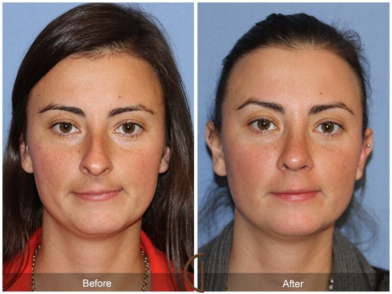 Female Rhinoplasty Before & After Photo