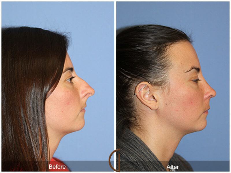 Female Rhinoplasty Before & After Photo