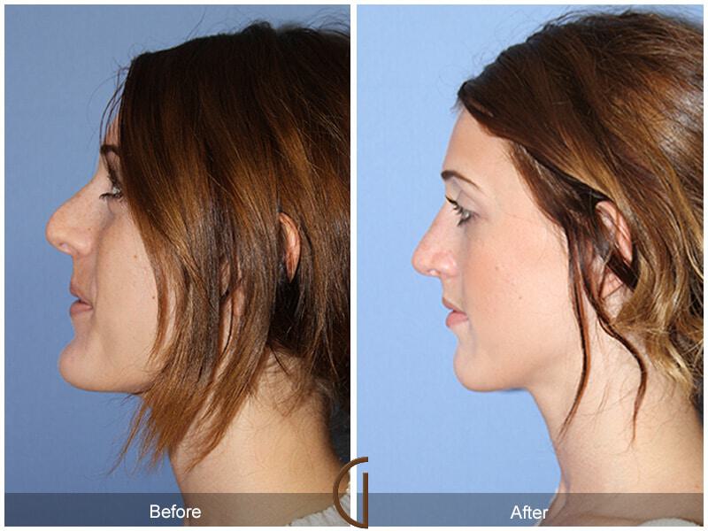 Female Rhinoplasty Before & After Photo