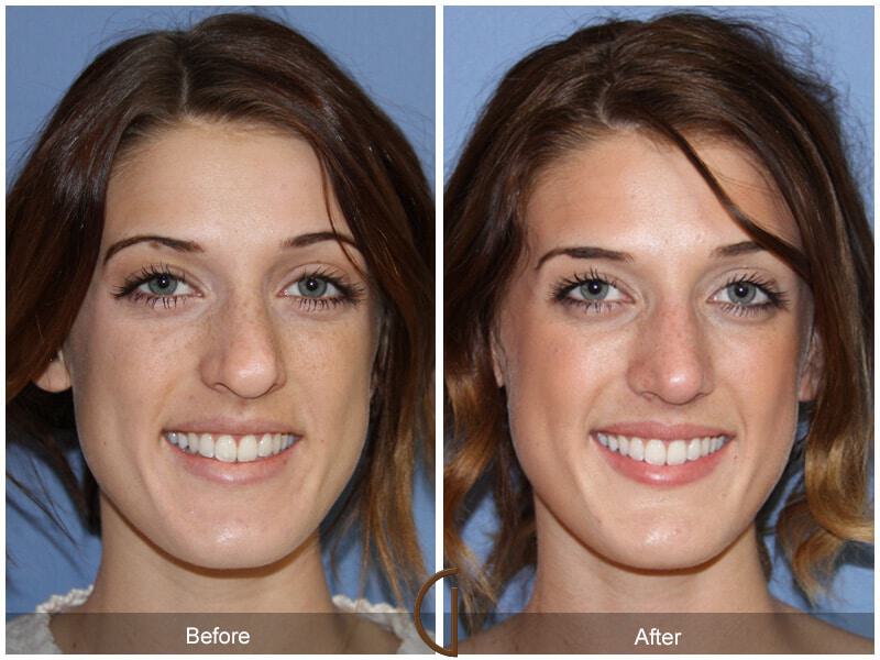 Female Rhinoplasty Before & After Photo