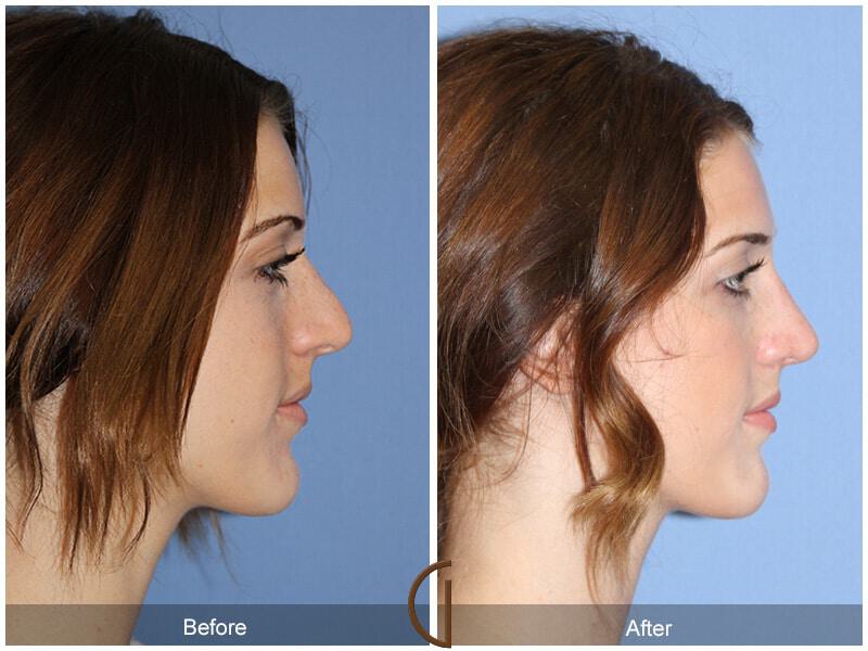 Female Rhinoplasty Before & After Photo