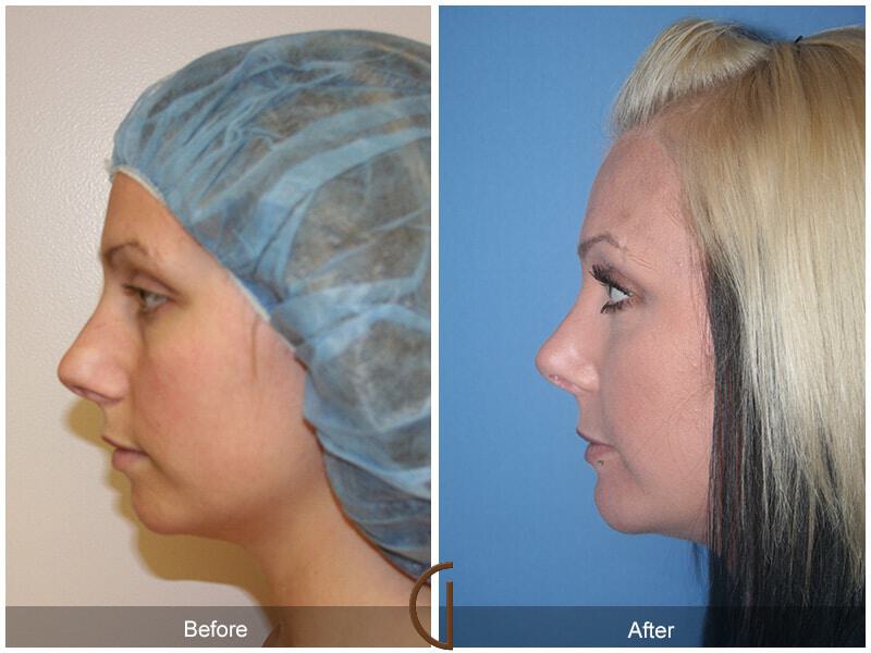 Female Rhinoplasty Before & After Photo