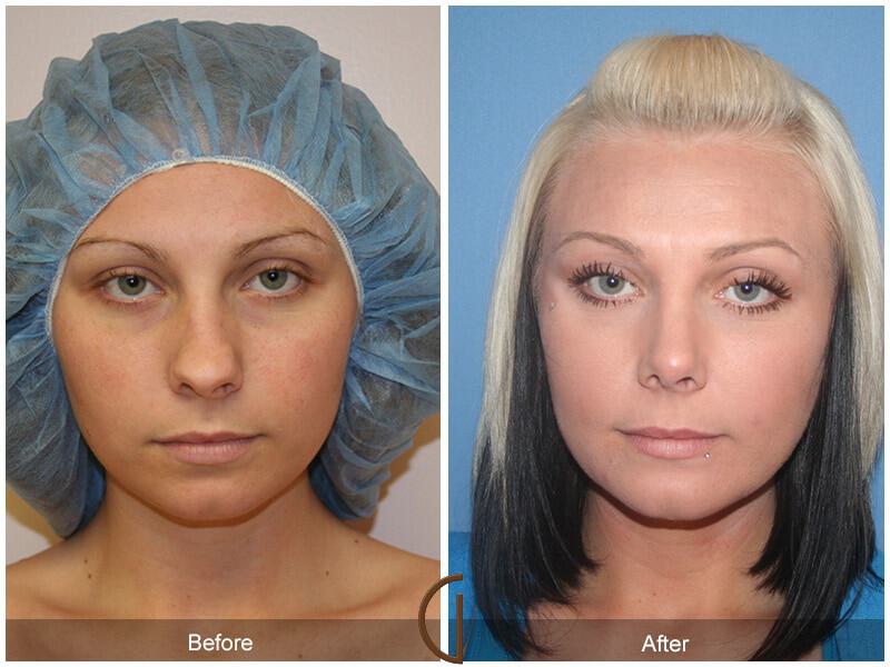 Female Rhinoplasty Before & After Photo