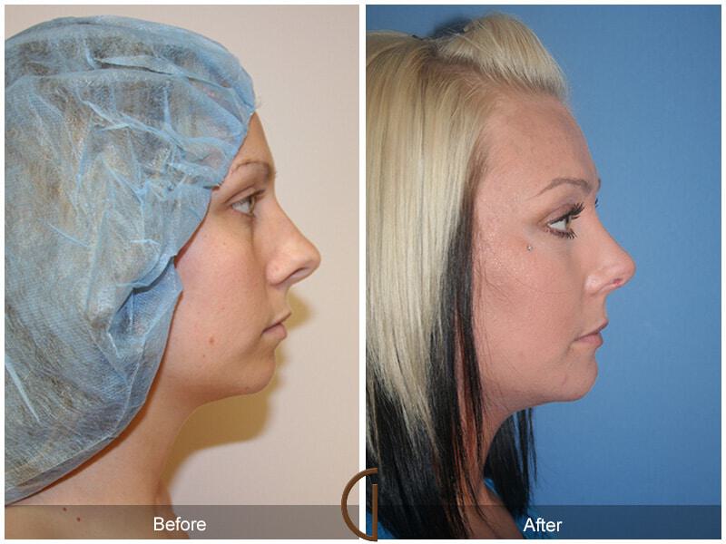 Female Rhinoplasty Before & After Photo