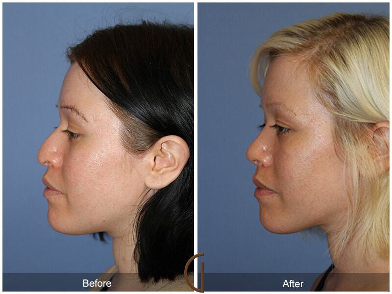 Female Rhinoplasty Before & After Photo