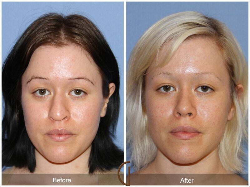 Female Rhinoplasty Before & After Photo