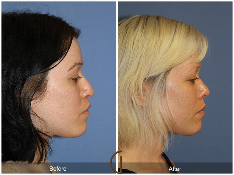 Female Rhinoplasty Before & After Photo