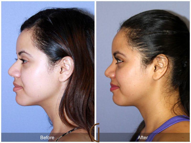 Female Rhinoplasty Before & After Photo