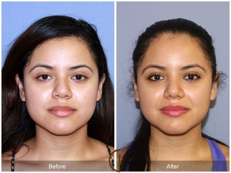 Female Rhinoplasty Before & After Photo