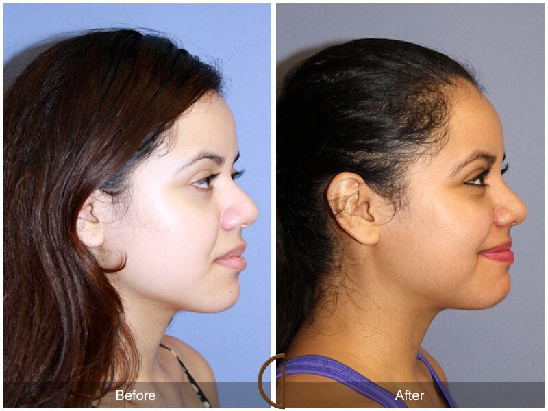 Female Rhinoplasty Before & After Photo