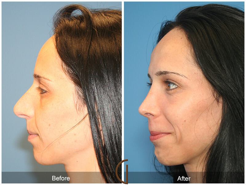 Female Rhinoplasty Before & After Photo