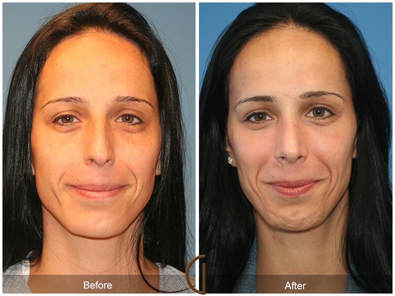 Female Rhinoplasty Before & After Photo