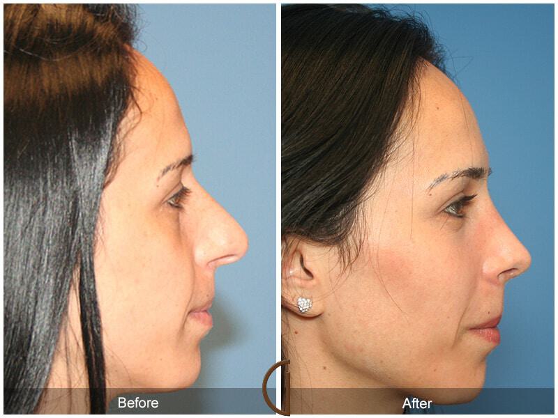 Female Rhinoplasty Before & After Photo