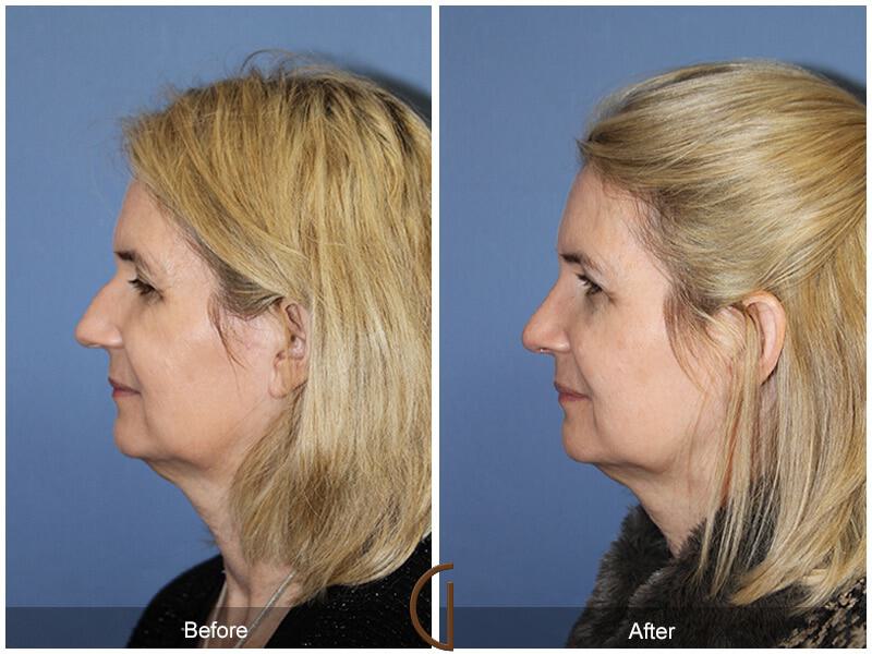 Female Rhinoplasty Before & After Photo