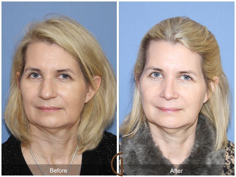 Female Rhinoplasty Before & After Photo