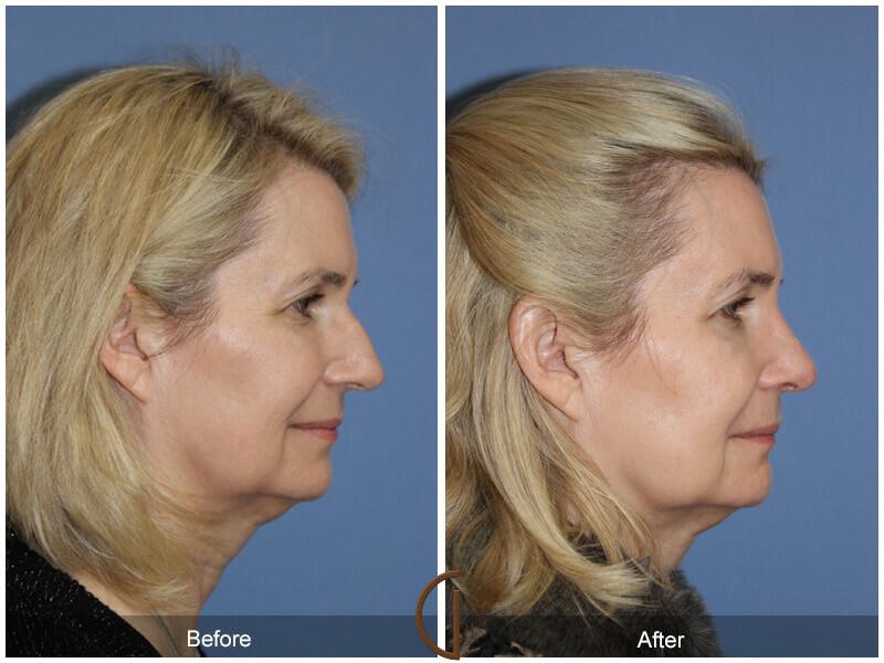 Female Rhinoplasty Before & After Photo