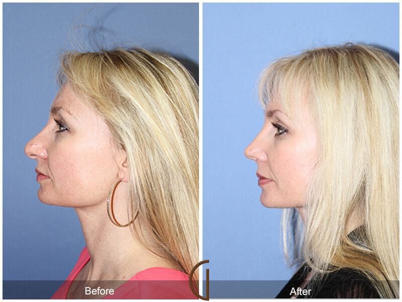 Female Rhinoplasty Before & After Photo