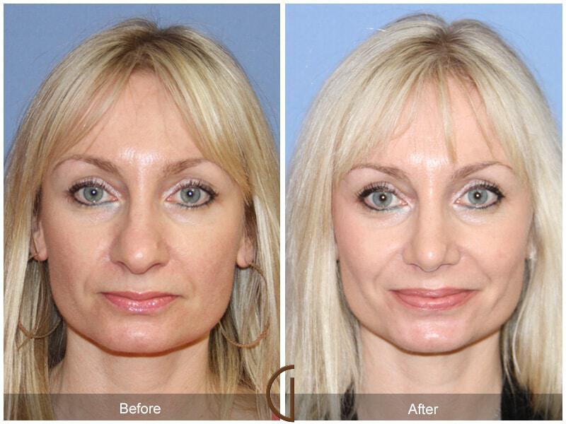 Female Rhinoplasty Before & After Photo