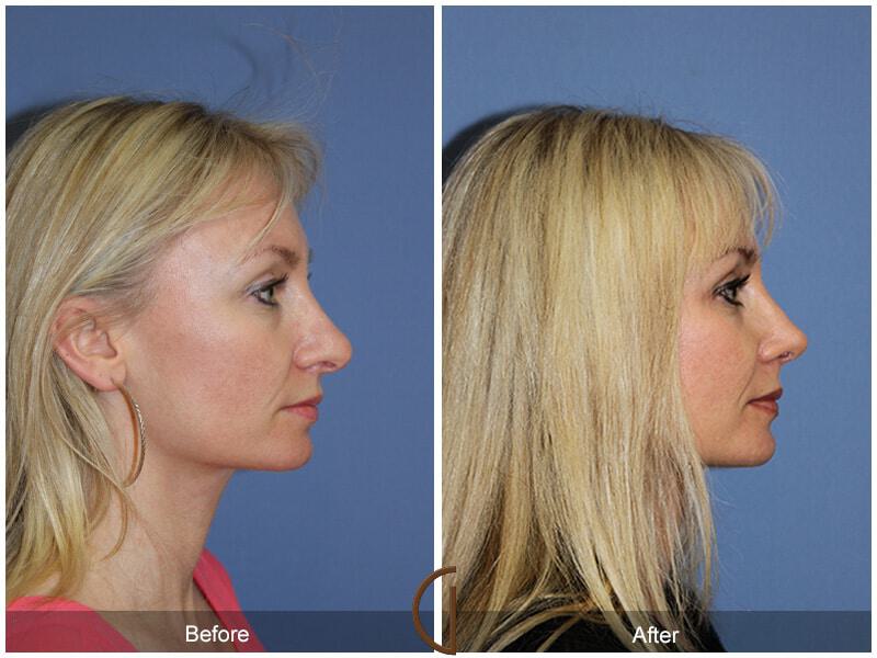 Female Rhinoplasty Before & After Photo