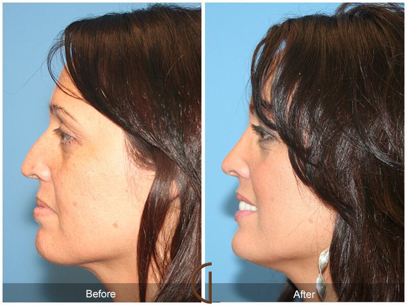 Female Rhinoplasty Before & After Photo